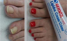 Педикюр: ногти (до и после)